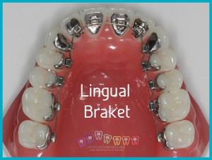 Lingual braket