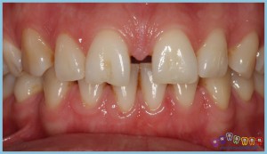 dişler-arası-boşluk-ortodontik-problemler-ortognatik-cerrahi