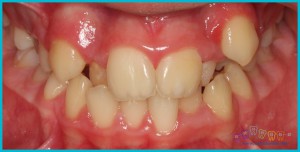 dişlerde-çapraşıklık - ortodontik-problemler-1