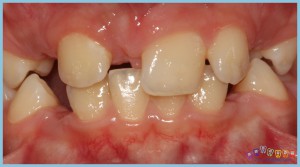 eksik-dişler-ortognatik-cerrahi-ortodontik-problemler