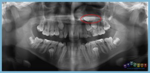 gömük-dişler-ortodontik-problemler-ortognatik-cerrahi