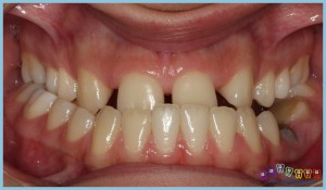 çapraz-kapanış-crossbite-ortodontik-problemler