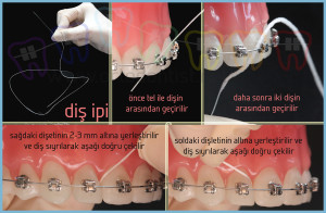 ortodontik tedavide diş ipi kullanımı ortodontist