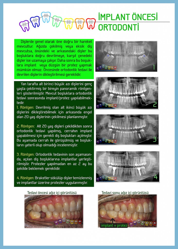 yetişkinlerde-ortodontik-tedavi